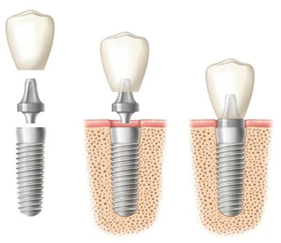 Diagram of three phases of a dental implant. 1 - Three separate pieces - fixture, abutment, and crown. 2. Implant fixture in bone with abutment and crown hovering over it. 3. Implant fixture in bone with abutment and crown attached - from Kentucky Dental Group of Lexington.