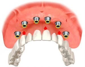Diagram of implant overdentures with the denture teeth suspended below the bone arch and implants, from the office of Kentucky Dental Group in Lexington.