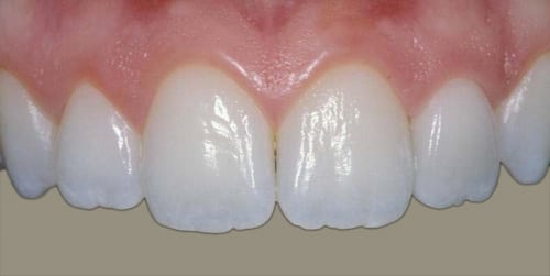 Photo of six upper front teeth, one of which is a porcelain crown, for an example of natural looking restorations, also available from Kentucky Dental Group of Lexington.
