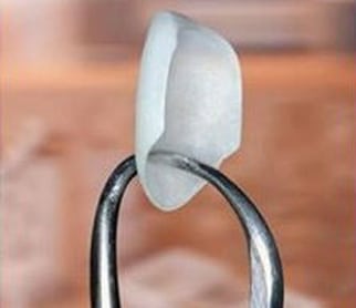 Close-up photo of the tips of dental forceps holding a single porcelain veneer--from Kentucky Dental Group of Lexington.