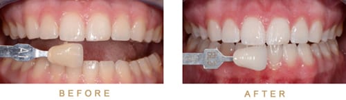 Close-up photos of teeth and gums for an example of before-and-after results of teeth whitening from Kentucky Dental Group of Lexington.