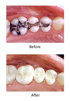 Before-and-after photos of lower molar teeth for mercury-free dentistry from Kentucky Dental Group of Lexington.