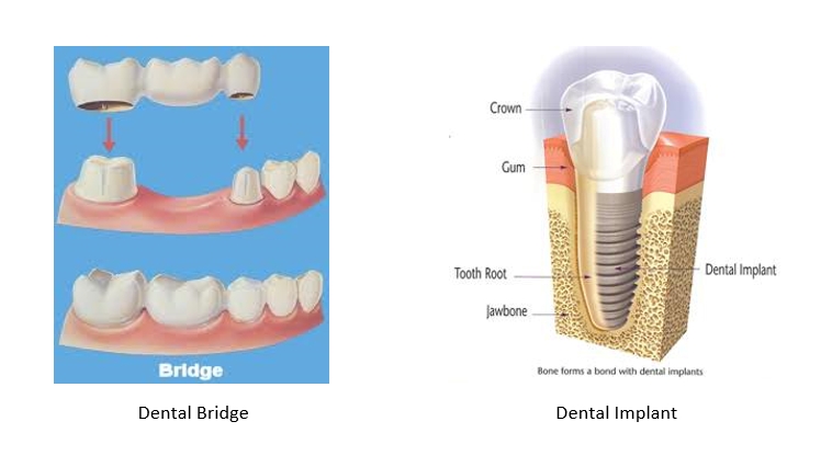 dental implant versus bridge
