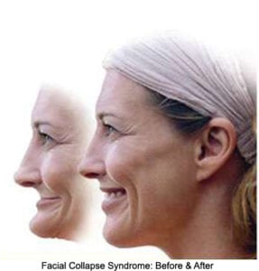 illustration of a woman's profile before and after facial collapse