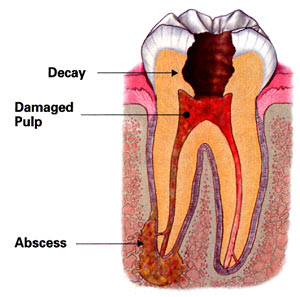 Image of an abcessed tooth