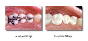 Before and after mercury-free fillings