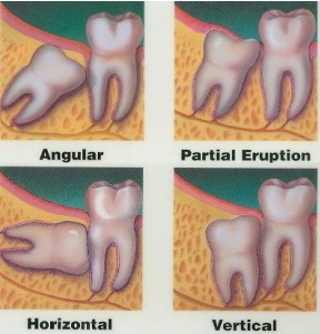 A diagram showing four examples of impacted wisdom teeth