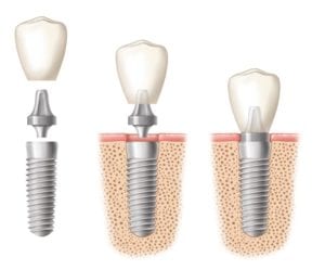 Dental implant in three images