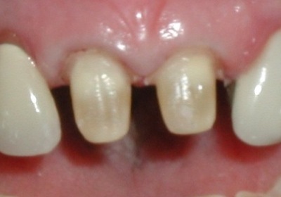 tooth prepped for dental crown