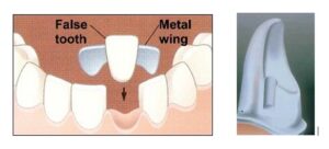 Illustrations of a Maryland Bridge and it's tooth preparaton